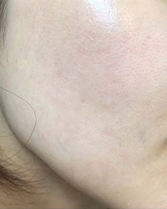 After treatment