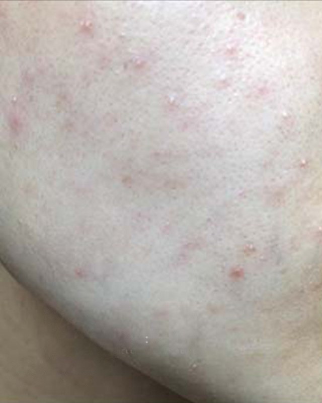 Before treatment