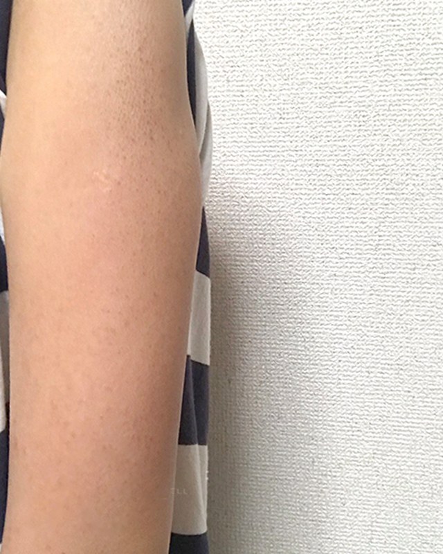 After treatment