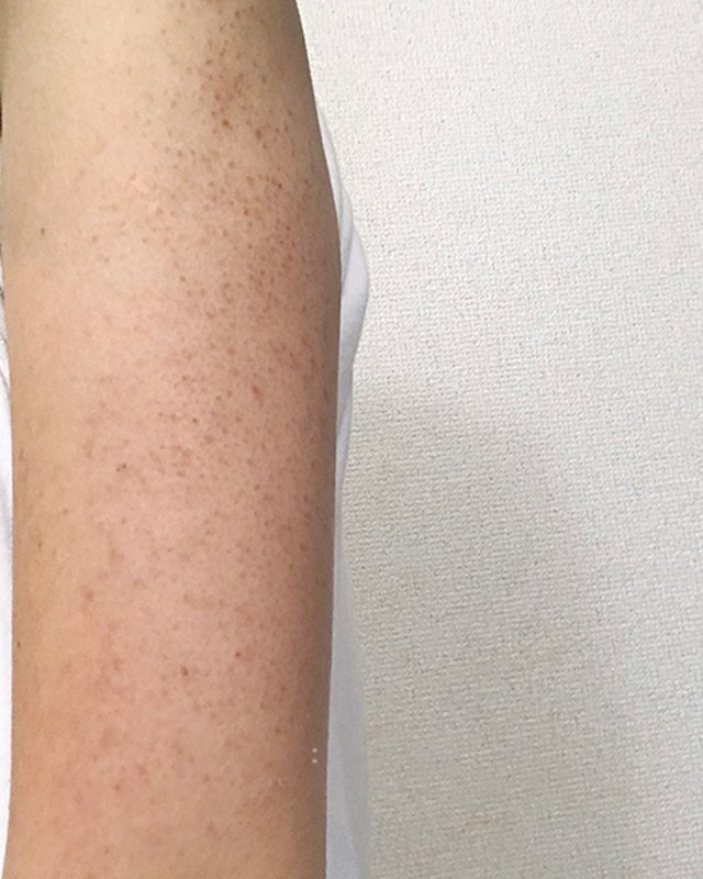 Before treatment