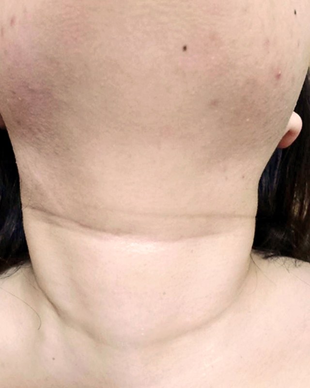 After treatment
