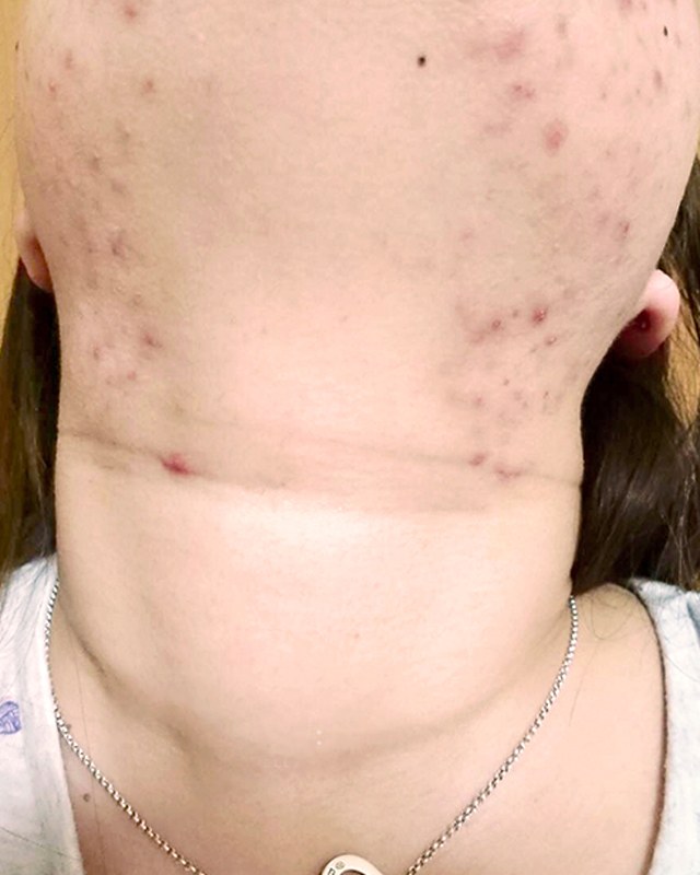 Before treatment