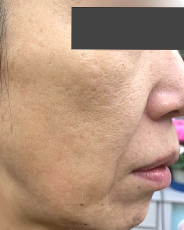 After treatment