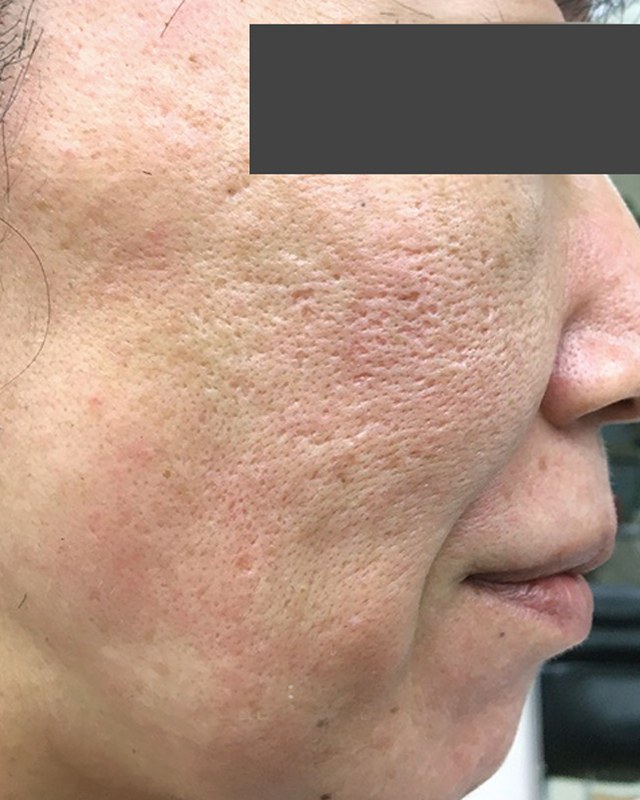Before treatment