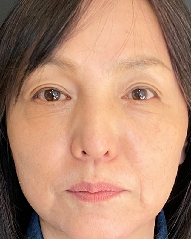 After treatment