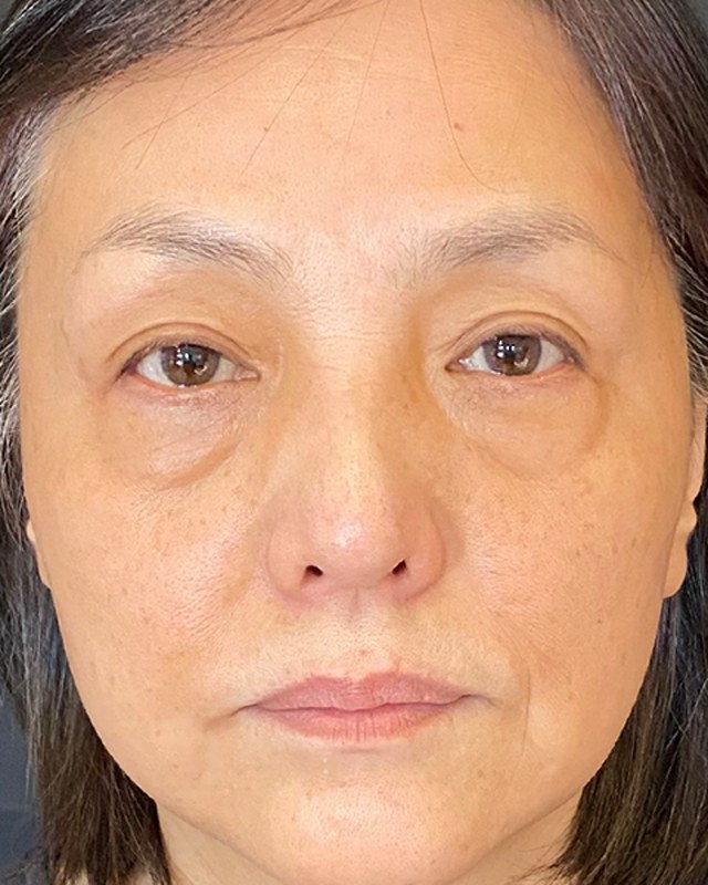 Before treatment