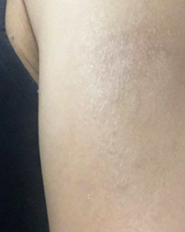 After treatment