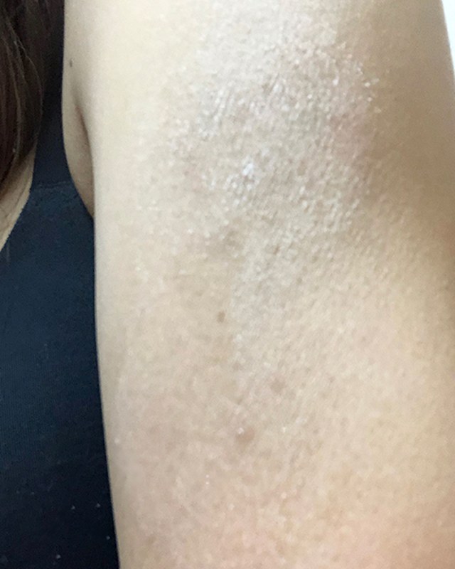 Before treatment