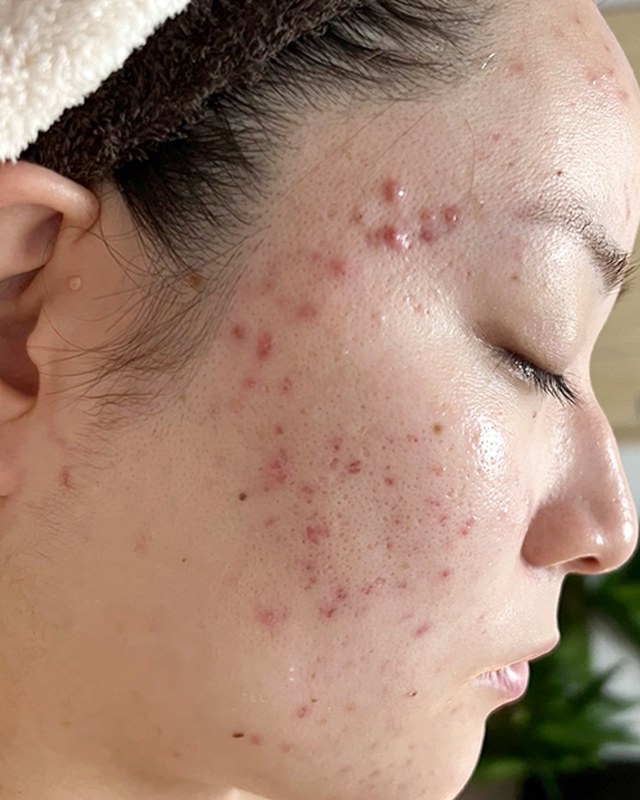 Before treatment