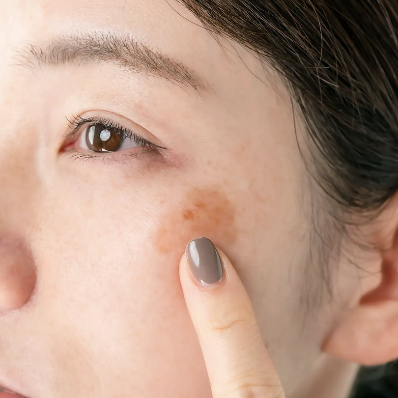 A woman pointing to a dark spot on her cheek