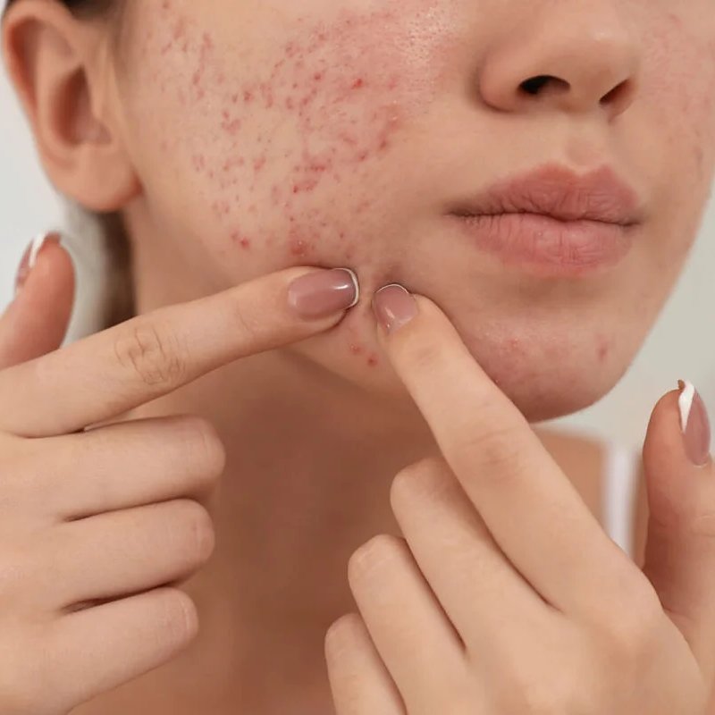 A woman touching acne and rough texture on her cheek