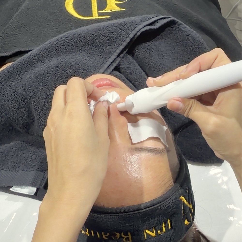 A therapist performing HydraFacial extraction around the nose